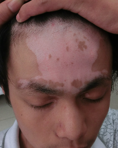 如何有效预防男性白癜风