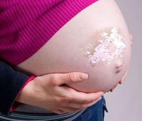孕妇白癜风患者在治疗期间需要注意哪些饮食