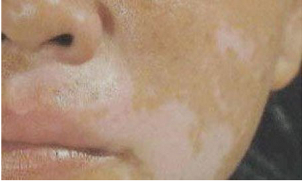 出现在男性的脸上的白斑有什么危害?