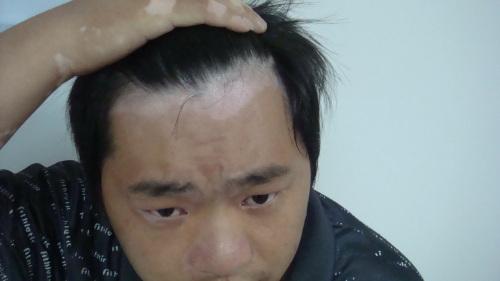 北京治疗白癜风医院：男性白癜风的原因是什么